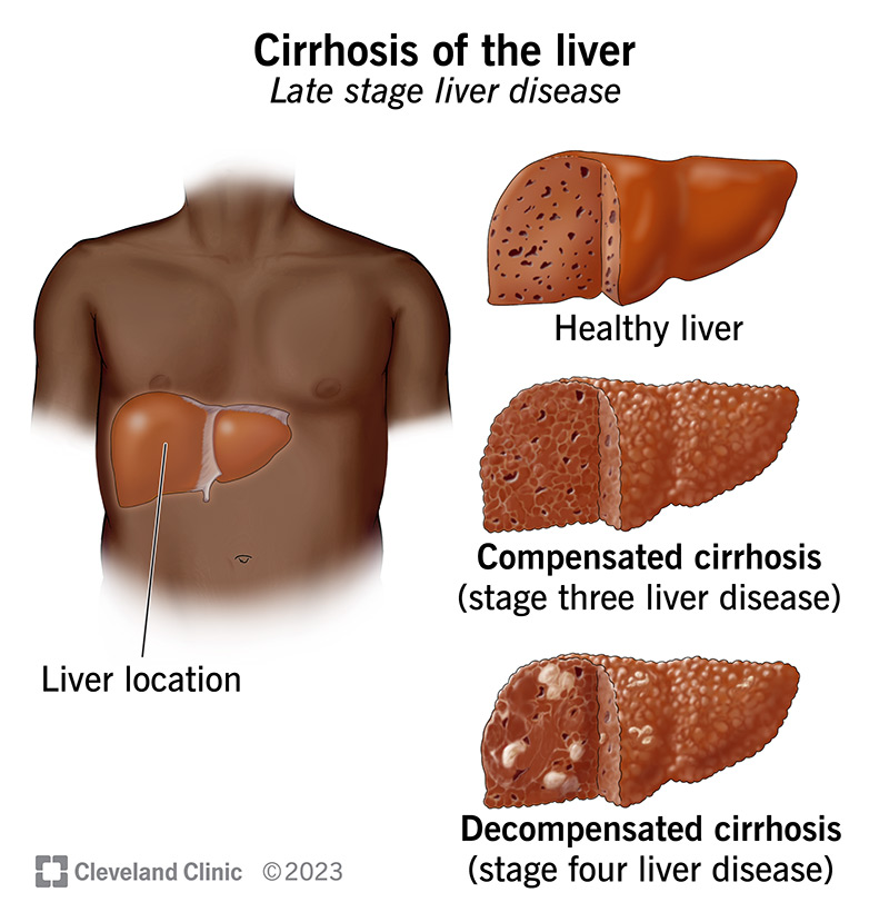 <ul><li><p>Chronic liver damage leading to scarring and liver failure</p></li><li><p>Worsened by excess alcohol consumption</p></li><li><p>Symptoms include fatigue, weakness, weight loss. In later stages patients may develop jaundice, gastrointestinal bleeding, abdominal swelling, and confusion</p></li></ul>