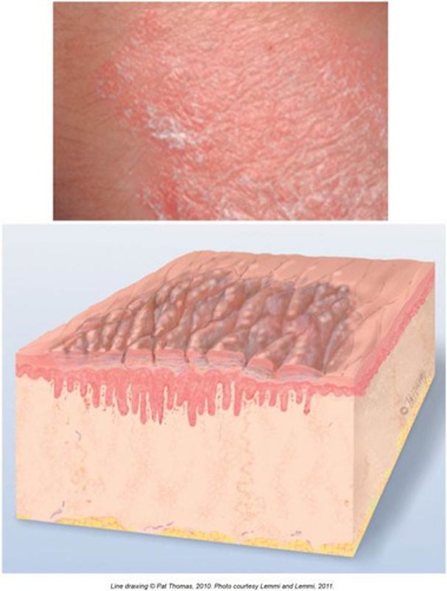 <p>formed from prolonged intense scratching, skin thickens and produces thickly packed pustules</p>