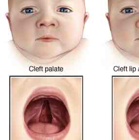 <p>Congenital split in the roof of the mouth or upper lip</p>