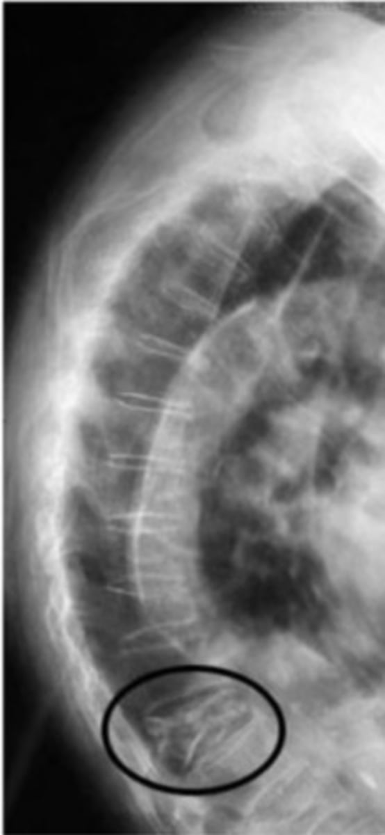 <p>What pathological condition is circled in the image below?</p>