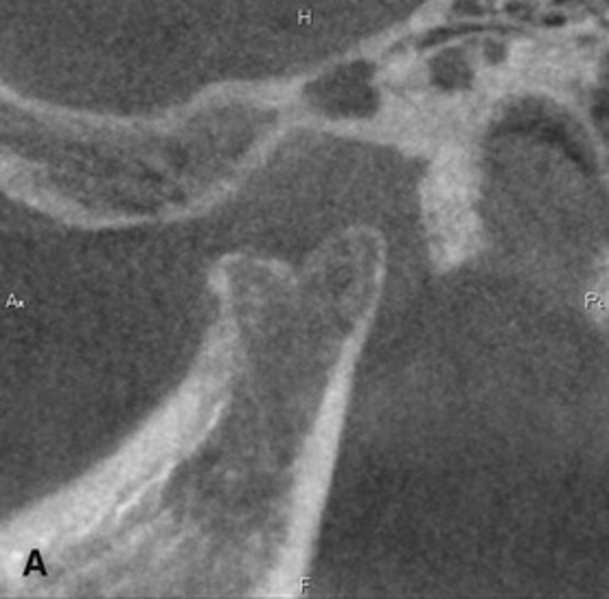 <p>What is this developmental abnormality, and what is the etiology for it?</p>