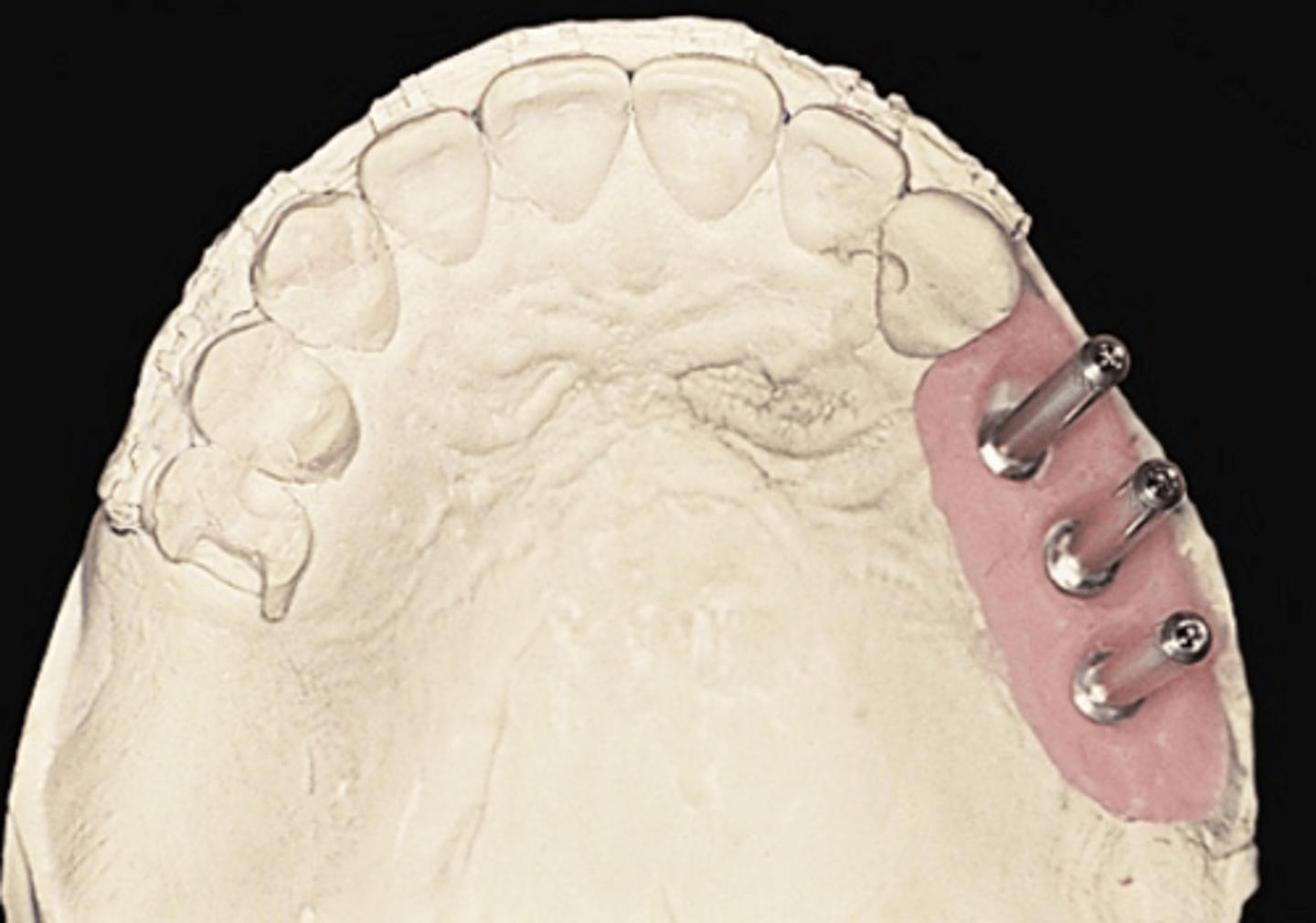 <p>What can be used as a guide pin on the cast?</p>