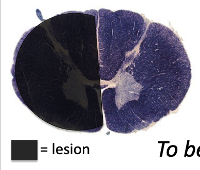 <p>a lesion in the black area would cause what type of lesion?</p>