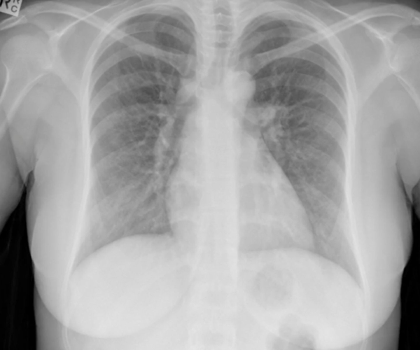 <p>(evaluating AP CXR) widened paratracheal stripe</p>