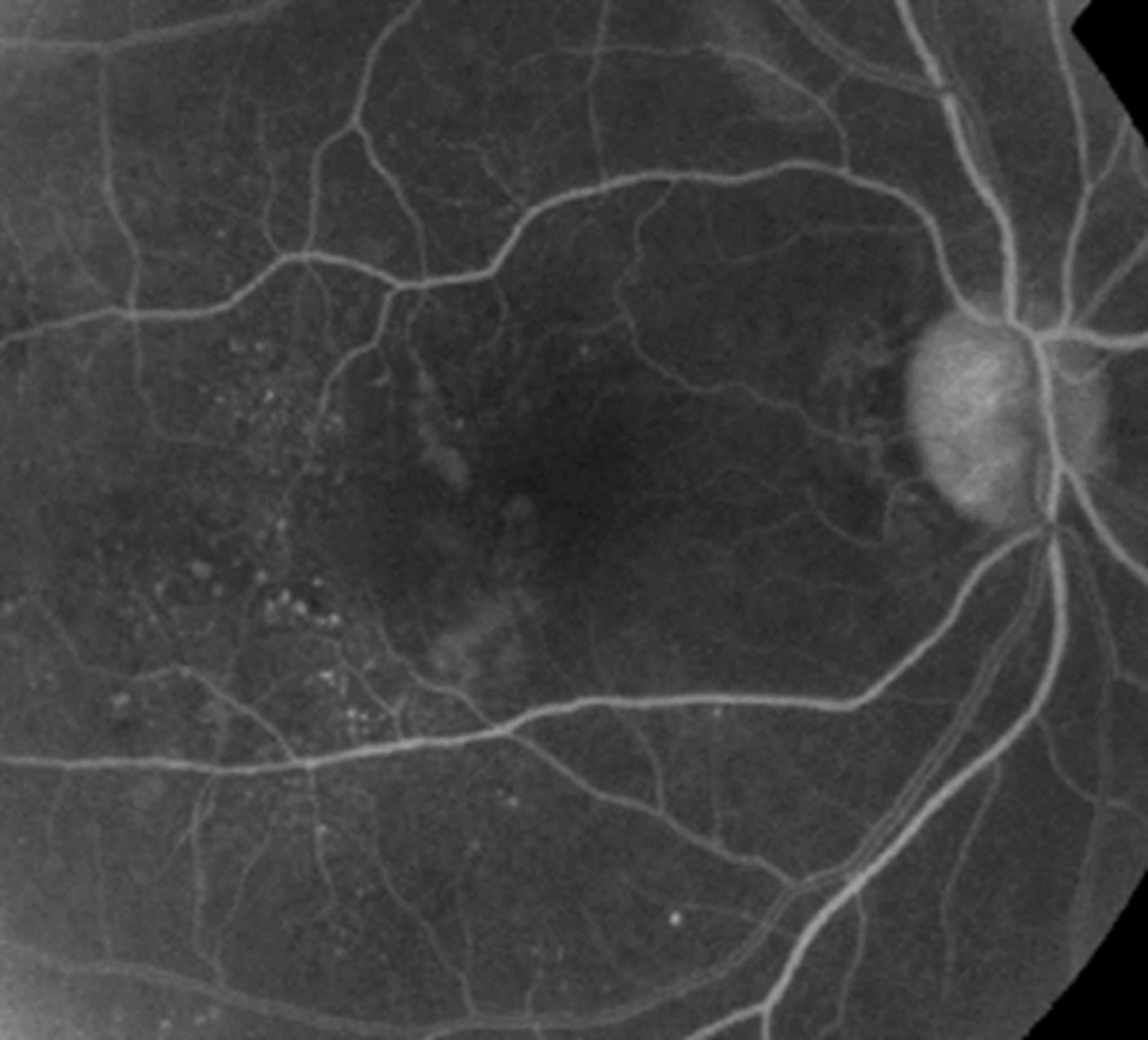 <p>Small out-pouch of an capillary wall</p><p>May be the direct result of an increase in pressure from a sclerosed arteriole</p><p>-Usually near AV crossing change</p><p>Often associated with CWS</p><p>Difficult to visualize</p><p>-Best seen with IVFA</p>