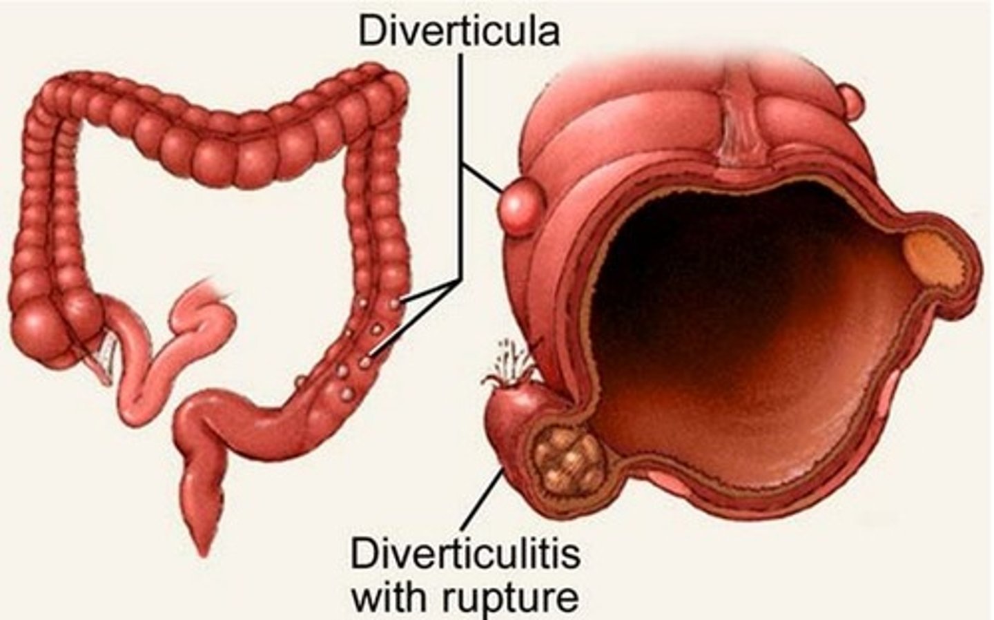 <p>Small bulging pouches that can form in the lining of the digestive system.</p>
