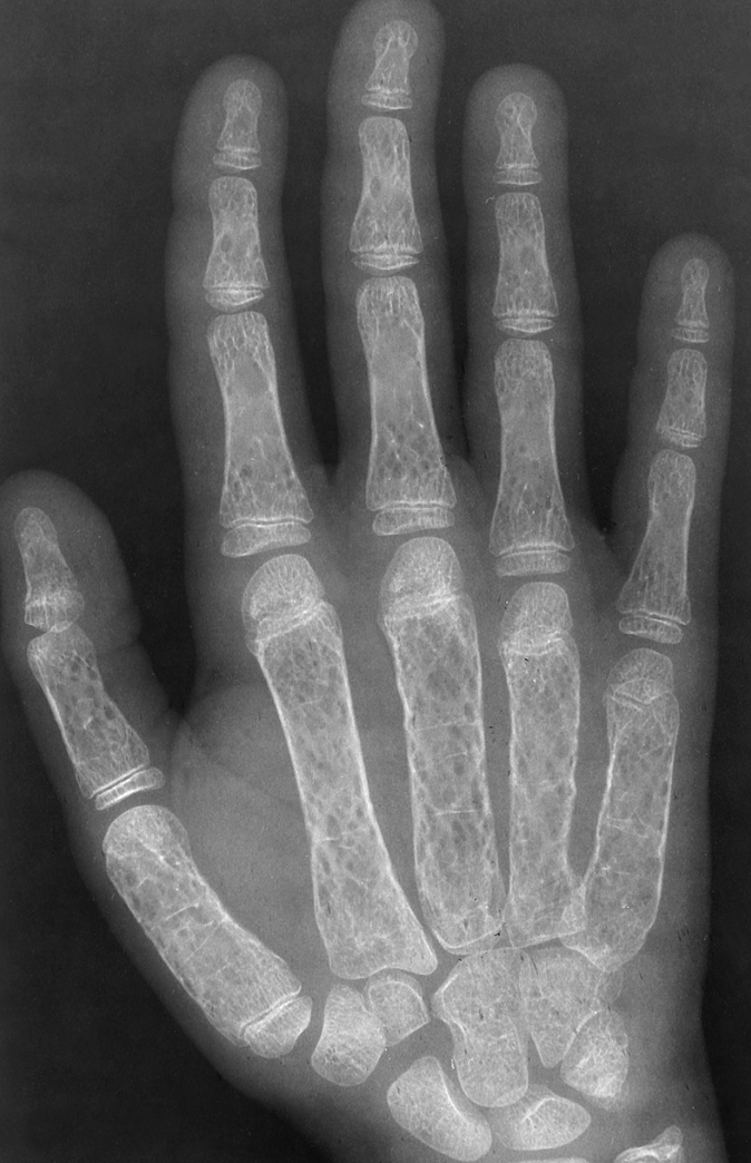 <p><strong>A defect in hemoglobin formation</strong>&nbsp;which occurs predominantly in persons living near the Mediterranean Sea, especially those of Italian, Greek, or Sicilian descent</p><p></p><p>bone thinning</p>