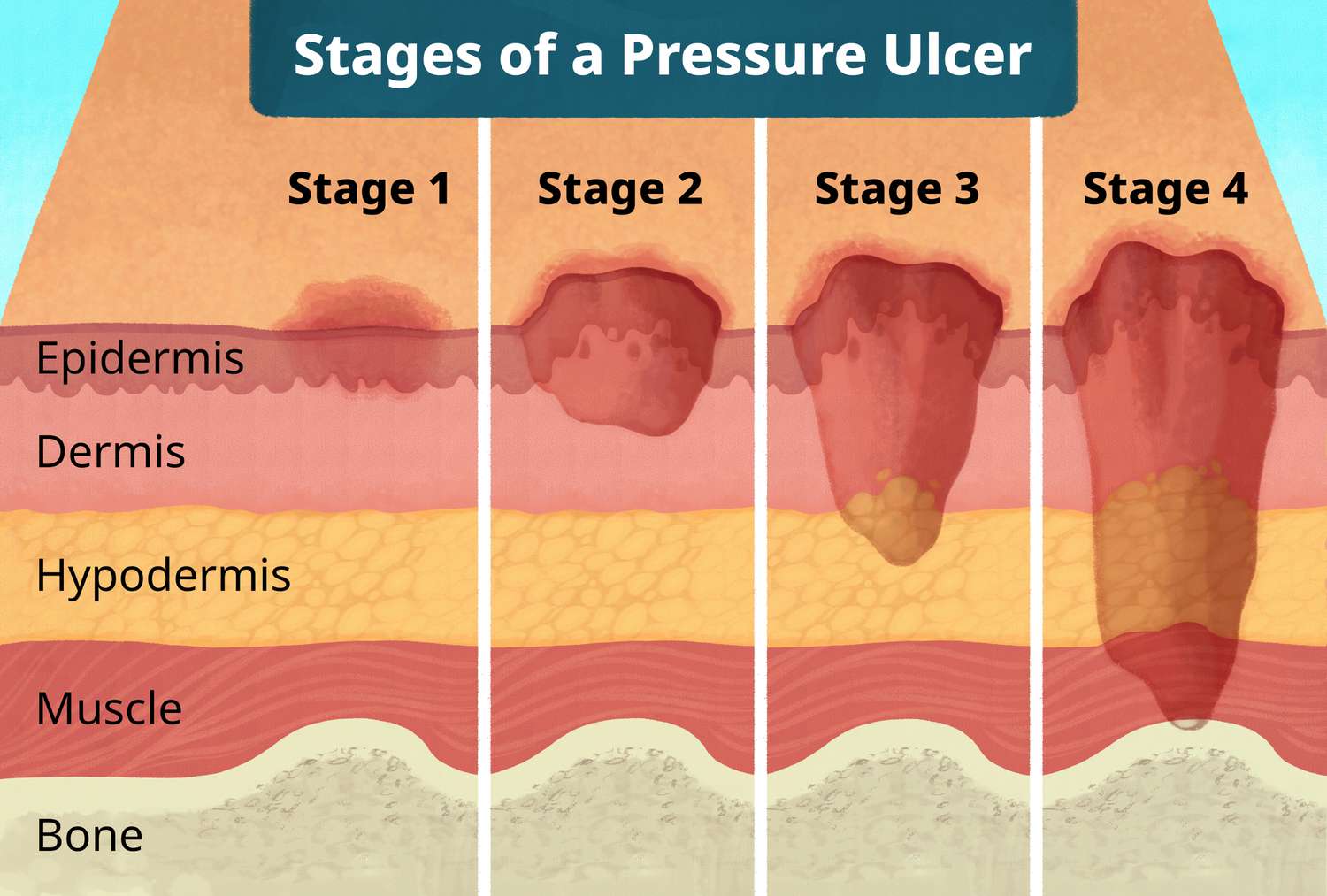 <p>Stage II: partial-thickness skin loss; superficial ulcer</p><p>involving epidermis or dermis</p>