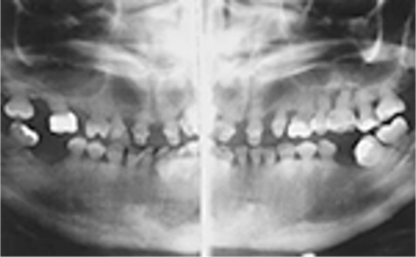 <p>incomplete or improper development of dentin tissue, between enamel and cementum</p><p>-short roots and almost complete lack of pulp chambers</p>