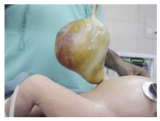 <p><span><strong>A 1 day old newborn is in the NICU for evaluation. He was born at term, via uncomplicated delivery. The mother did not receive prenatal care. She admits to smoking 2-3 cigarettes daily, no drug or alcohol use. There is no evidence of cyanosis and he moves his extremities well. Abdominal exam is shown below. The pathogenesis of the patient’s condition involves?&nbsp;</strong></span></p><ul><li><p><span>A congenital defect in the pleuroperitoneal membrane&nbsp;</span></p></li><li><p><span>Failed closure of the caudal fold&nbsp;</span></p></li><li><p><span>Failure of the extra embryonic gut to return to the abdominal cavity&nbsp;</span></p></li><li><p><span>Incomplete closure of the umbilical ring following physiological herniation of the intestines&nbsp;</span></p></li><li><p><span>Incomplete rotation of the midgut in utero&nbsp;</span></p></li></ul><p></p>