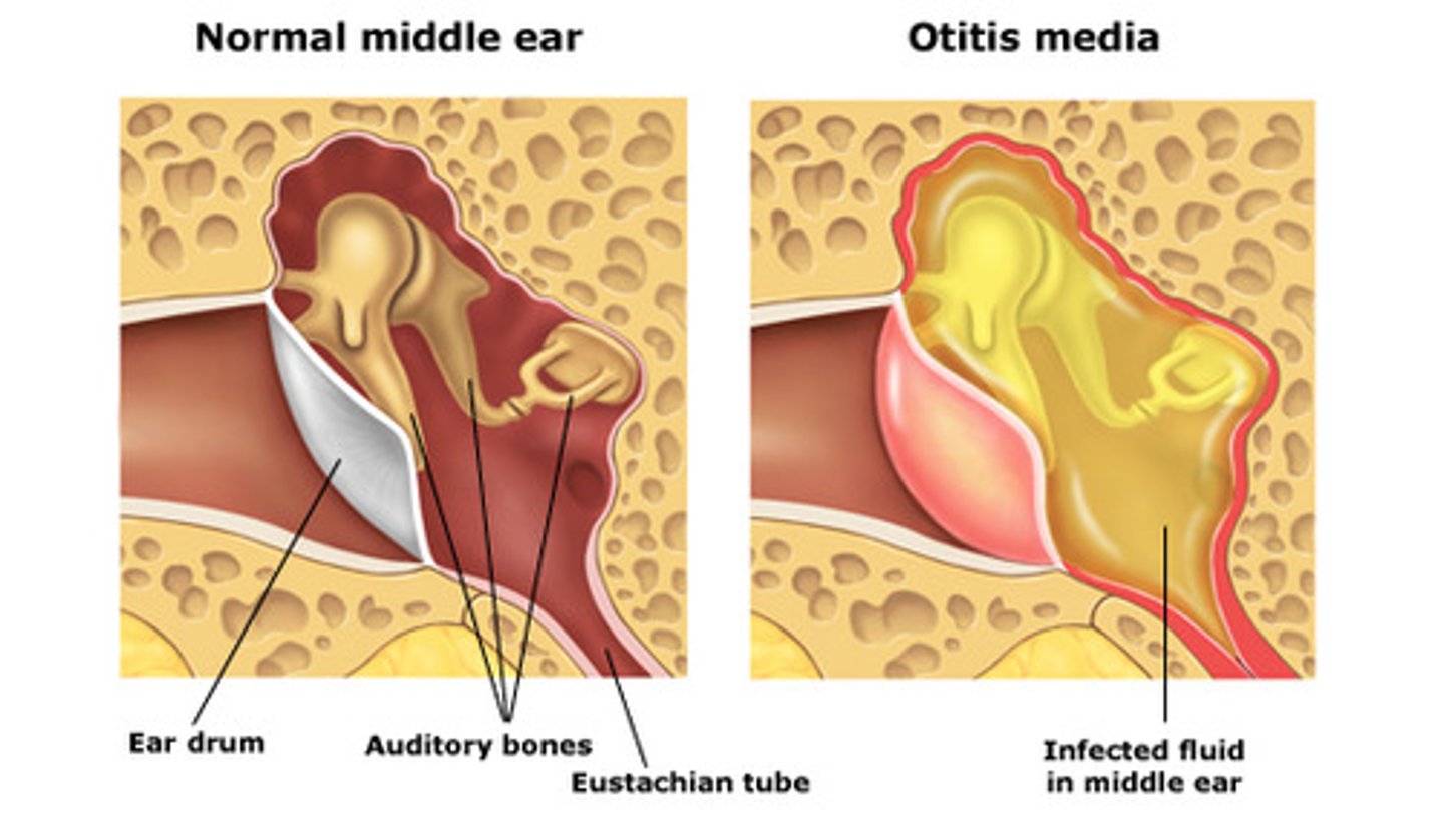 <p>Middle ear infection.</p>