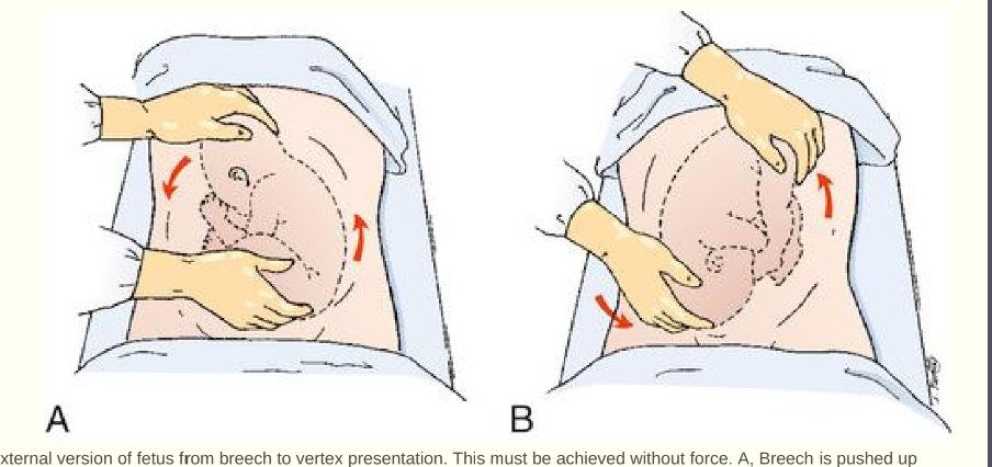 <p> An attempt to turn the fetus from a breech or shoulder presentation to a vertex presentation for birth</p><p>§ At 37 weeks, the success rate for ECV is approximately 65% and the risk for cesarean birth is reduced by 50%</p><p>§ Ultrasound scanning used during procedure</p><p>§ NST and Informed consent before procedure</p><p>§ Contraindications to ECV</p>
