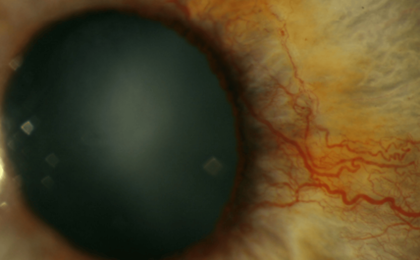 <p>neovascularization of the iris due to retinal ischemia most often occurring at the pupil border, but may also migrate into the angle. Is associated with diabetes mellitus and should be documented if it is or isn't present. Can also be seen in patients having central retinal vein occlusion. Can cause ectropion uvea due to contraction of blood vessels.</p>