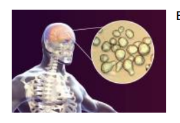 <ul><li><p>Brain infection (Cryptococcal meningitis): </p></li><li><p><strong>Acquired from the lung </strong></p></li><li><p>Fungus crosses the blood-brain barrier</p></li><li><p><strong><em>Headache, sensitivity to light, nausea, confusion/behavioural changes</em></strong></p></li></ul><p></p>