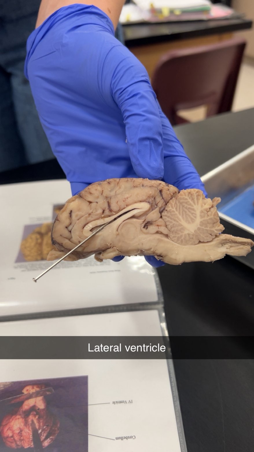 <p>lateral ventricle</p>