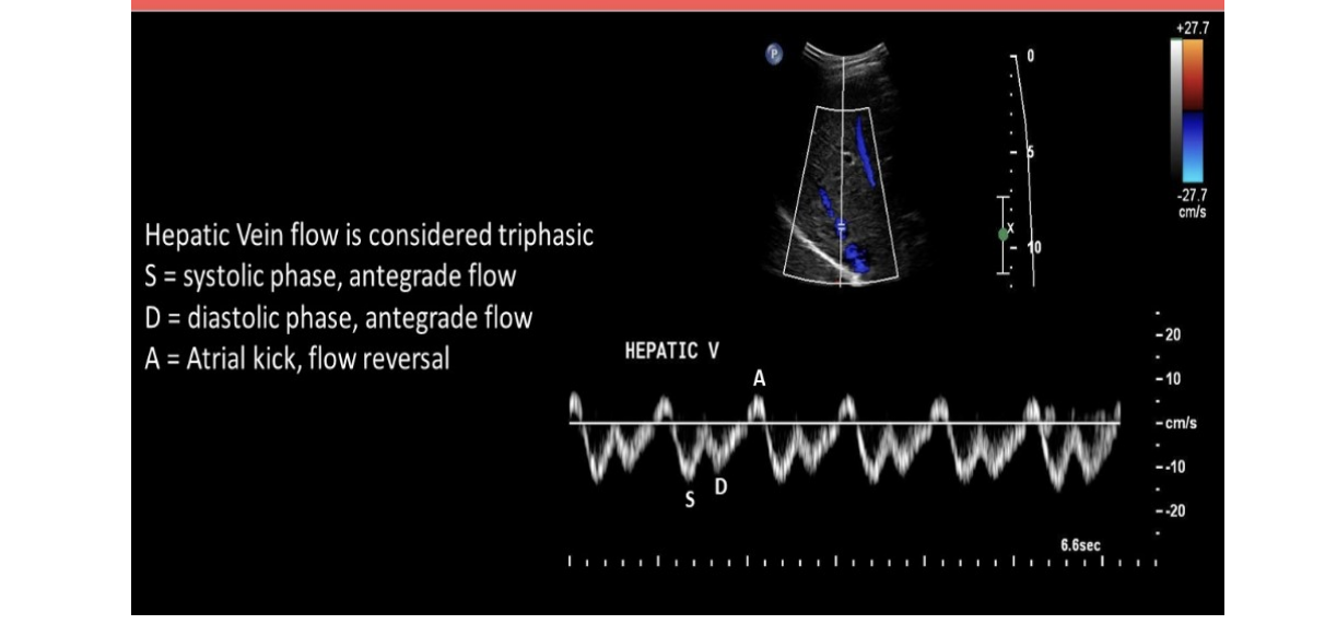 <p>normal hepatic venous flow will show </p><p>.</p><p>a) 2 large RETROgrade diastolic + systolic waves follow by a small ANTEgrade component that corresponds w/atrial contraction </p><p>b) 2 large RETROgrade diastolic + systolic waves follow by a small RETROgrade component that corresponds w/atrial contraction </p><p>c) 2 large ANTEgrade diastolic + systolic waves follow by a small ANTEgrade component that corresponds w/atrial contraction </p><p>d) 2 large ANTEgrade diastolic + systolic waves follow by a small RETROgrade component that corresponds w/atrial contraction </p>