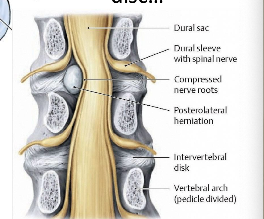 <p>will usually compress the roots of the spinal nerve emerging through the  intervertebral foramen BELOW</p>