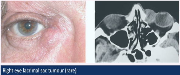 <ul><li><p>rare</p></li></ul><p></p><ul><li><p><strong>Painless swelling</strong> </p></li></ul><p></p><ul><li><p>Punctual reflex of pus + <strong><u>blood </u></strong></p></li></ul><p></p><p>image: swelling at inner corner of eye biopsy, revealing a rare tumour of lacrimal sac → vast majority of swelling in this area due to being expansions of lacrimal sac</p><p></p>
