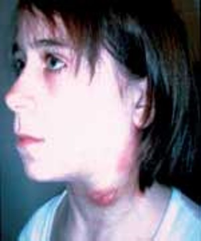 <ul><li><p>Inflammation of the lymph vessels</p></li><li><p>Commonest cause bacteria called streptococcus pyogenes (most common).</p></li><li><p>Lymph vessels appear as red streaks through the skin</p></li></ul>