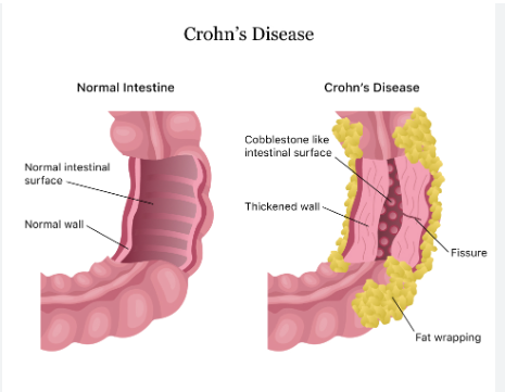 <p><span style="font-family: Droid Sans Mono, monospace">CROHN’S DISEASE</span></p>