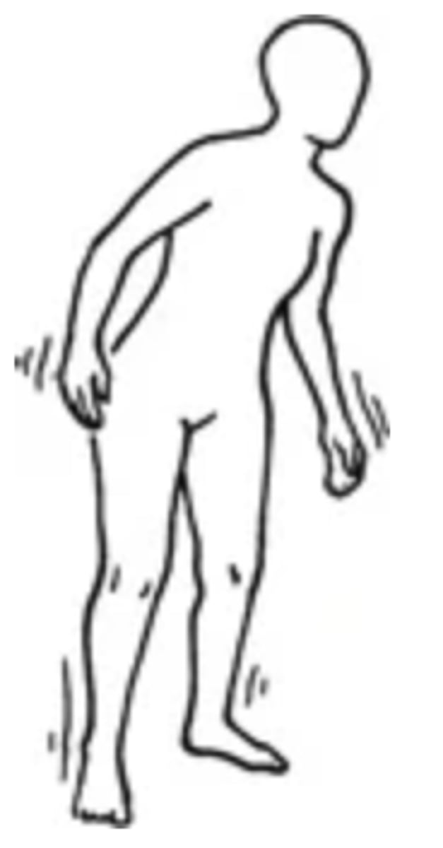 <p>- An abnormal gait in which the person has staggering, wide-based gait; difficulty with turns; uncoordinated movement</p><p>- Can be caused by alcohol, cerebellar tumour, or MS</p>