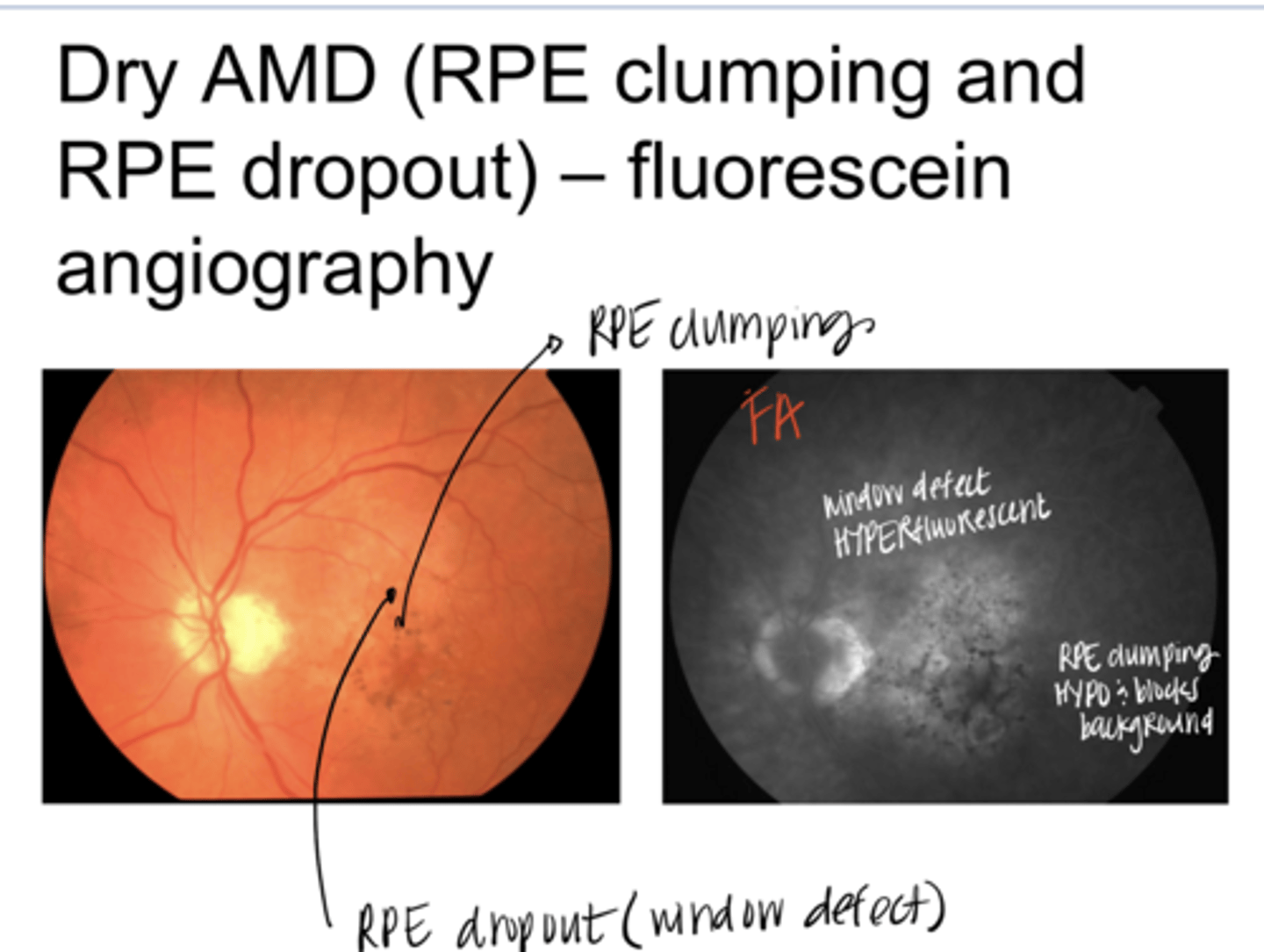 <p>RPE Clumping will be (hyper/hypo) fluorescent on FA</p>