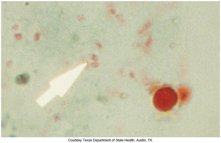 <p>Microsporadia diagnosis</p>