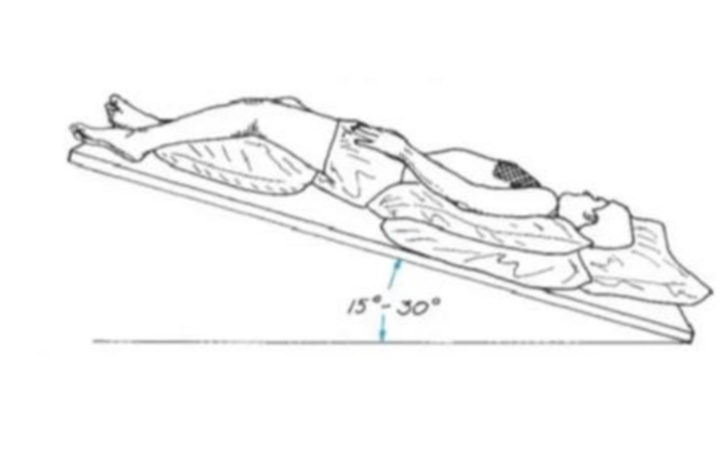 <p>patient lies one-quarter turn from supine on the right side, supported with pillows and in a 30 degree head-down position; percussion is applied just under the left breast</p>