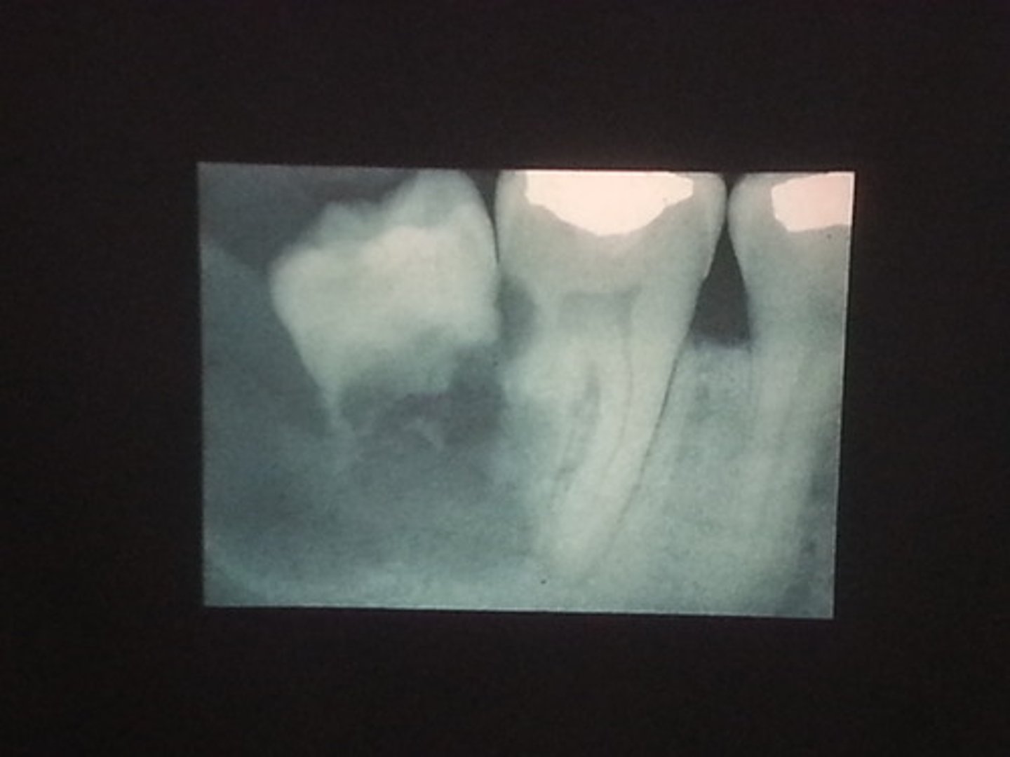 <p>dissolve. In this case, the primary teeth are resorbing from the pressure of the developing permanent teeth located directly below in the jawbone.</p>