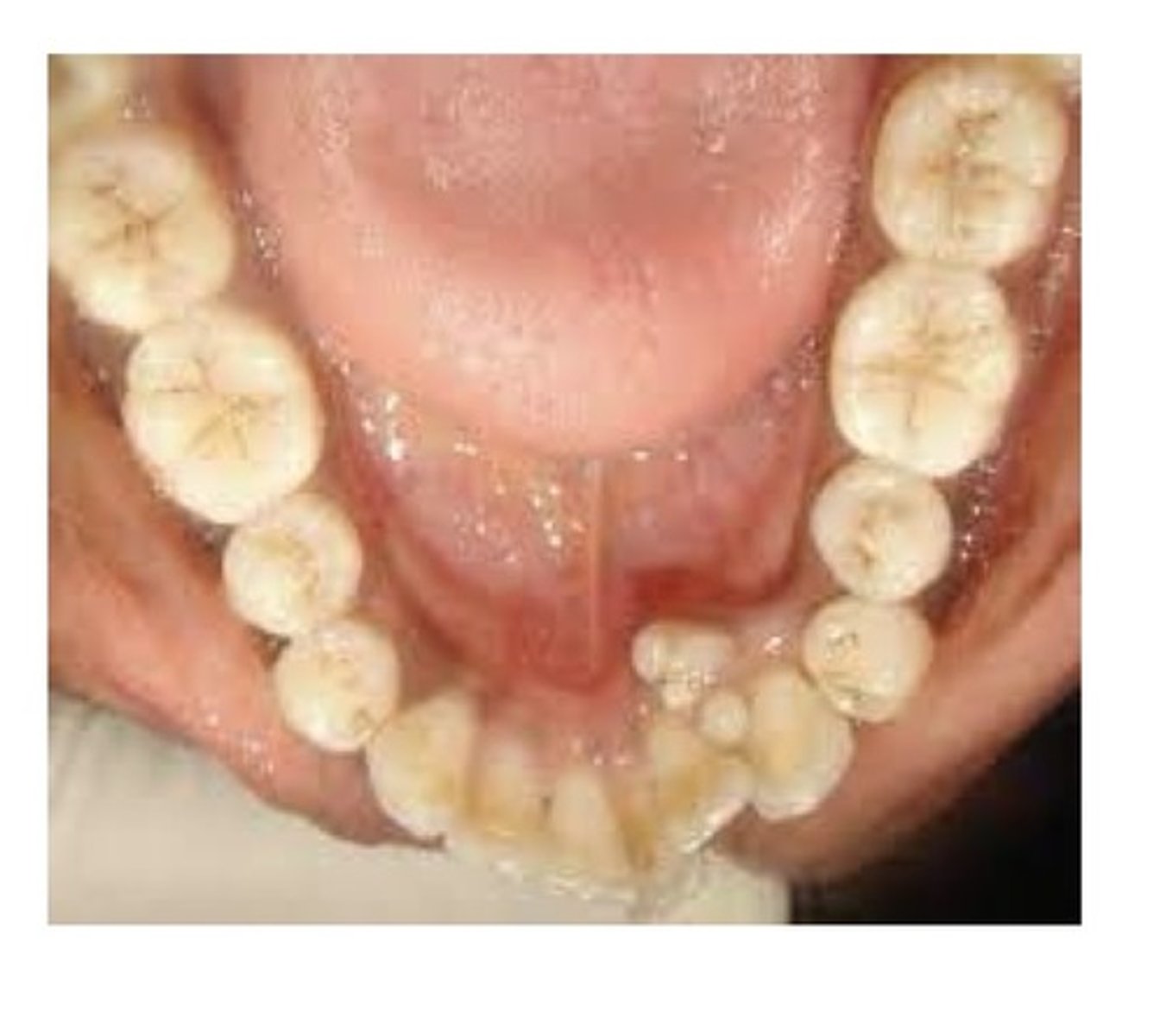 <p>An odontoma that resembles teeth usually in the anterior maxilla.</p>