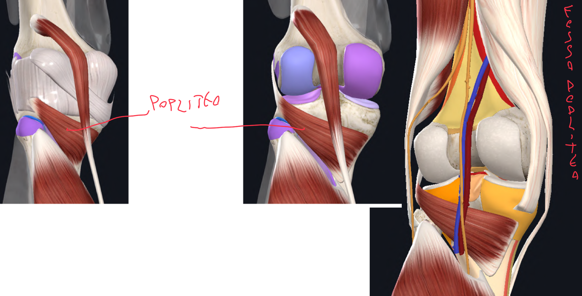 <p>POPLITEO:</p><ul><li><p>Origine → epicondilo laterale del femore</p></li><li><p>Inserzione → faccia posteriore della tibia sopra la linea solea</p></li><li><p>Attraversa la capsula fibrosa del ginocchio che presenta una discontinuità per il suo passaggio, infatti la separa dal menisco laterale</p></li><li><p>Funzione:</p><ul><li><p>A catena aperta, cioè quando la tibia si può muovere → rotazione mediale della tibia sotto il femore</p></li><li><p>A catena chiusa, cioè quando il piede e fisso al suolo → rotazione laterale del femore sopra la tibia</p></li><li><p>Il suo ruolo principale è per iniziare il movimento di flessione del ginocchio → quando siamo a ginocchio esteso, i condili femorali sono bloccati sulla tibia e i legamenti sono in massima tensione → per sbloccare il movimento, la contrazione del popliteo causa la rotazione mediale o laterale descritta sopra, così che i condili femorali possano riprendere il rotolamento.</p></li></ul></li></ul><p>FOSSA POPLITEA (forma losagna, rombo):</p><ul><li><p>Limiti:</p><ul><li><p>Superolaterale → muscolo bicipite femorale</p></li><li><p>Superomediale → semimembranoso e semitendinoso</p></li><li><p>Infero mediale e laterale → gastrocnemio</p></li><li><p>Pavimento → superficie poplitea femore, capsula articolare, muscolo popliteo</p></li></ul></li><li><p>Contenuto:</p><ul><li><p>Muscolo Plantare</p></li><li><p>Arteria Poplitea (ramo della femorale, giunta attraverso aito adduttorio)</p></li><li><p>Vena Poplitea</p></li><li><p>Nervo Fibulare Comune e Tibiale (rami terminali del nervo ischiatico)</p></li><li><p>In ordine latero-mediale e superficiale-profonda→ nervo, vena, arteria</p></li></ul></li><li><p>Clinica:</p><ul><li><p>Il polso popliteo è difficile da palpare, si deve chiedere al pz di flettere il ginocchio per rilassare i muscoli, e palpare profondamente nella parte mediale della fossa</p></li><li><p>L’aneurisma dell’arteria poplitea è l’aneurisma periferico più frequente</p></li></ul></li></ul><p></p>