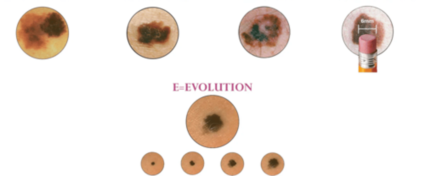<p>Asymmetrical sides</p><p>Border has indentations</p><p>Color is black/brown/tan</p><p>Diameter larger than 6mm</p><p>Elevation</p>