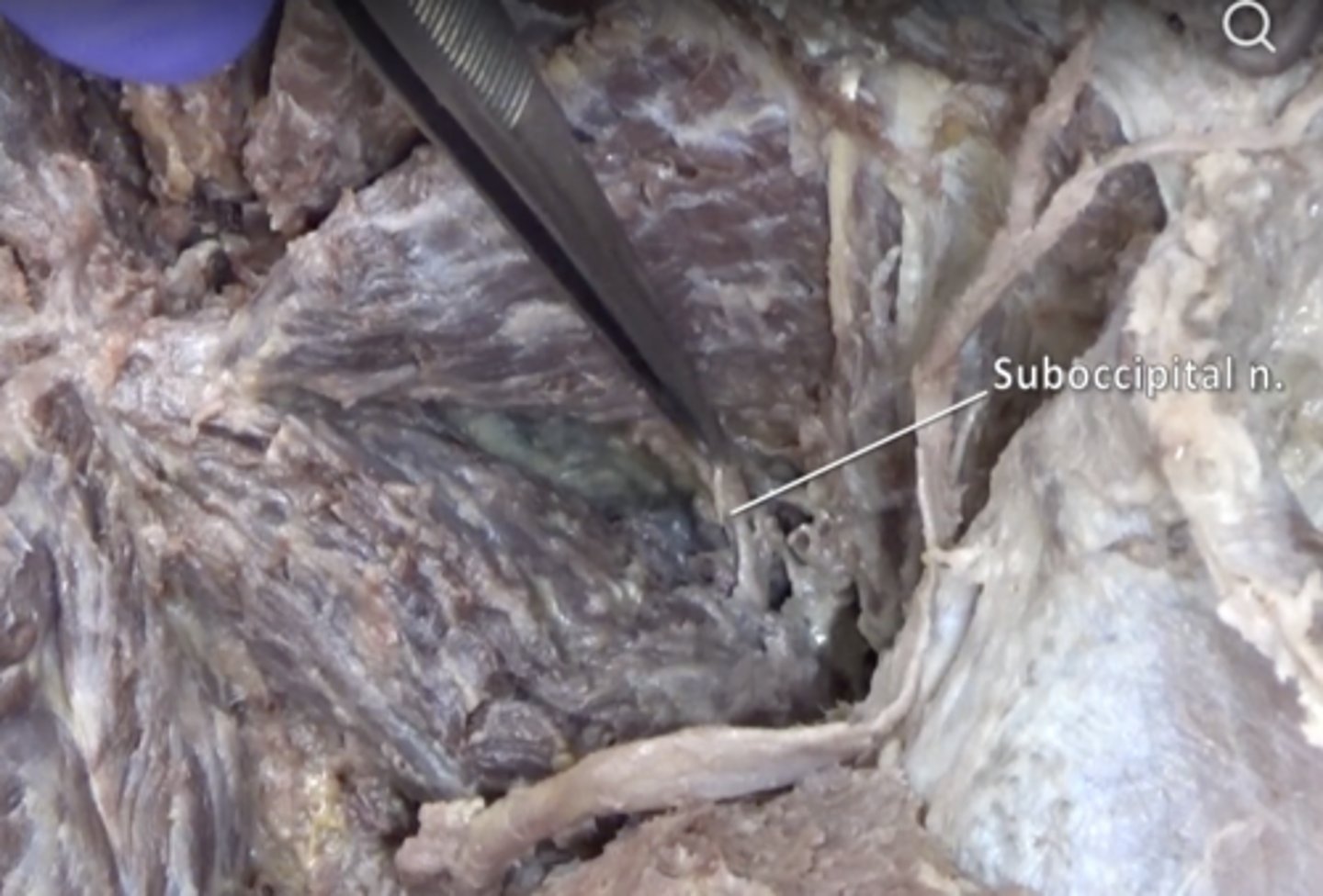 <p>Innervation of suboccipital muscles. Located between rectus capitis posterior major and obliquus capitis inferior</p>