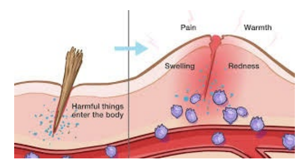 <p>- cytokines induce inflammation</p><p>- series of events in reaction to tissue damage - injury and/or infection</p><p>- site becomes swollen, red, hot and painful - part of normal healing process</p><p>- underlying mechanisms explain the symptoms</p><p>- Vasodilation - increase in blood vessel diameter and permeability - brings more WBCs to site of infection</p>