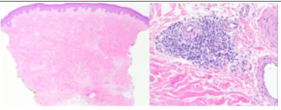 <p><span style="background-color: transparent; font-family: "Times New Roman", serif;">*Clinical signs: <strong>stiffened skin texture + Raynaud Phenomenon</strong></span></p><p><span style="background-color: transparent; font-family: "Times New Roman", serif;">*Skin biopsy: abundant collagen deposition</span></p><p><span style="background-color: transparent; font-family: "Times New Roman", serif;">*<strong>Anti-topoisomerase I (anti-Scl70):</strong> systemic sclerosis – autoantibodies vs enzymes that regulate over/underwinding of DNA</span></p>