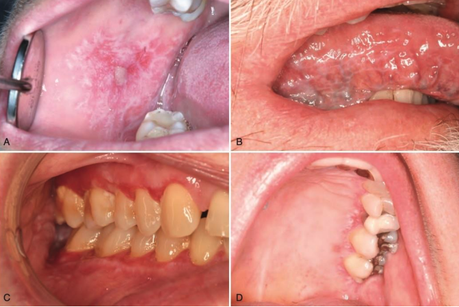 <p>the following are clinical features of what condition?</p><p>• Typically, bilateral and symmetrical</p><p>• Reticular/keratotic (Wickham striae)</p><p>• Ulcerative</p><p>• Erythematous/erosive</p>