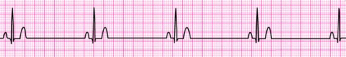 <p>You arrive on the scene to find a 56-year-old diabetic woman with dizziness. She is pale and diaphoretic. Her blood pressure is 80/60 mm Hg. The cardiac monitor documents the rhythm below. She is receiving oxygen at 4 L/min by nasal cannula and an IV has been established. Your next order is:</p><p>1. Dopamine at 2 to 10 mcg/kg per minute.</p><p>2. Sublingual nitroglycerin 0.4 mg.</p><p>3. Morphine sulfate 4 mg IV.</p><p>4. Atropine 0.5 mg IV .</p><p>5. Atropine 1 mg IV.</p>