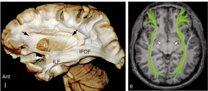 <p>Inferior Frontal Occipital Fasciculus (IFOF)</p>