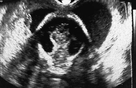 <p><span><span>This sonogram of an early second-trimester cranium is most suspicious for:<br></span></span></p>
