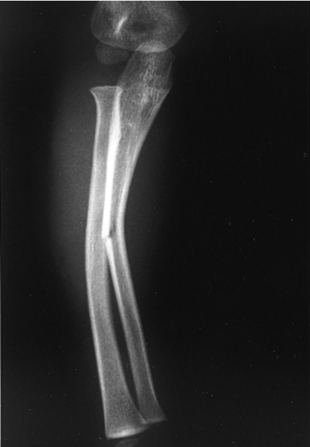 <p>what type of fracture is this?</p>