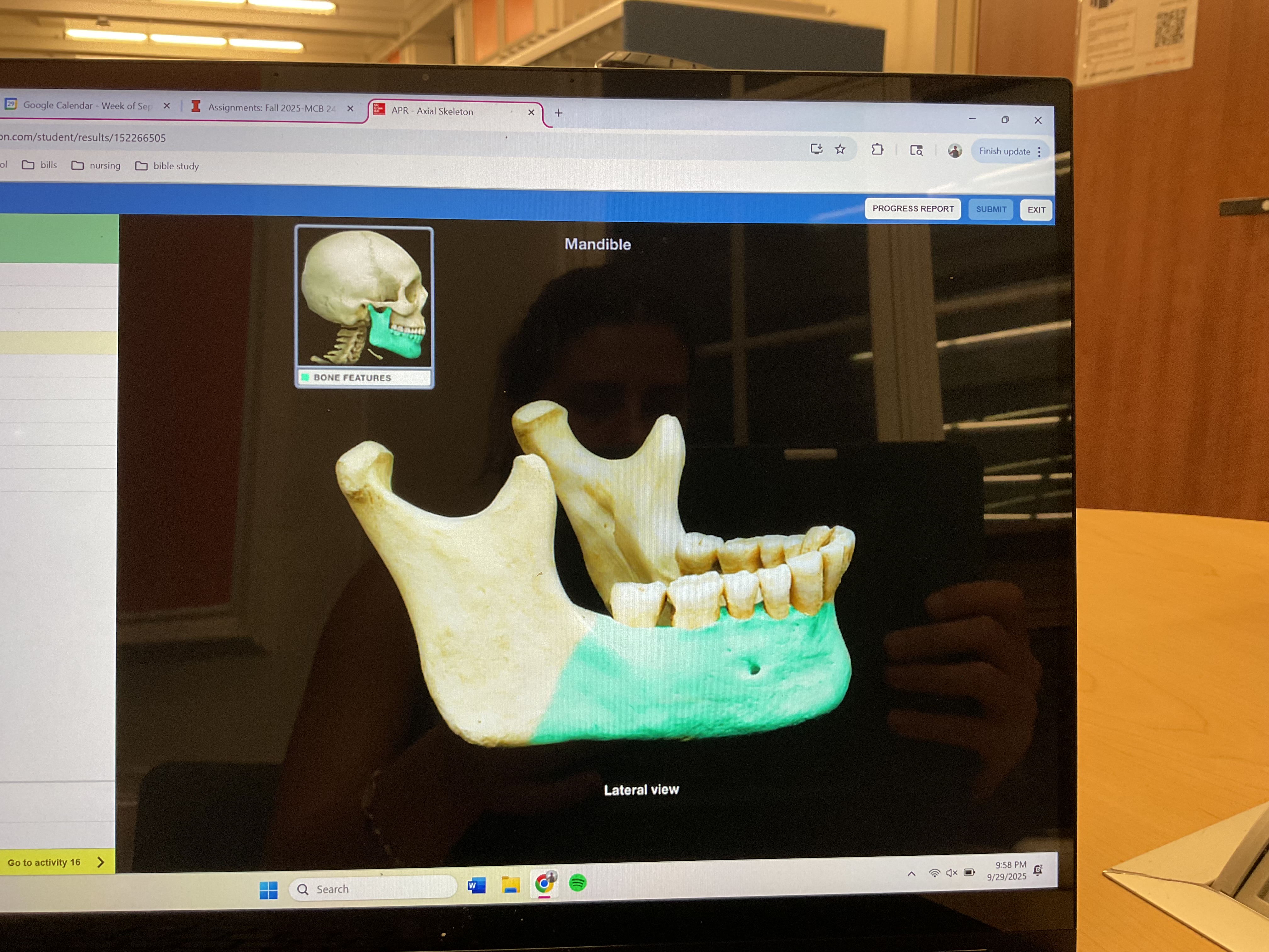<p>Body of mandible </p>