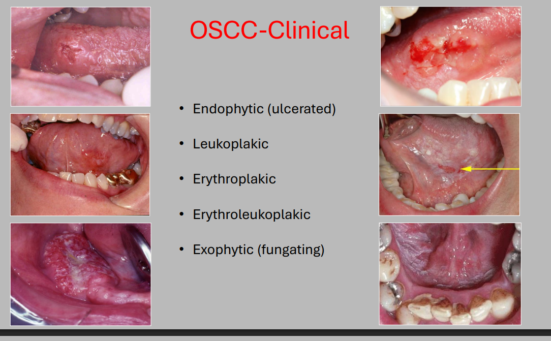 <ul><li><p>endophytic (ulcerated) </p></li><li><p>leukoplakic </p></li><li><p>erythroplakic </p></li><li><p>erythroleukoplakic </p></li><li><p>exophytic (fungating) </p></li></ul><p></p>