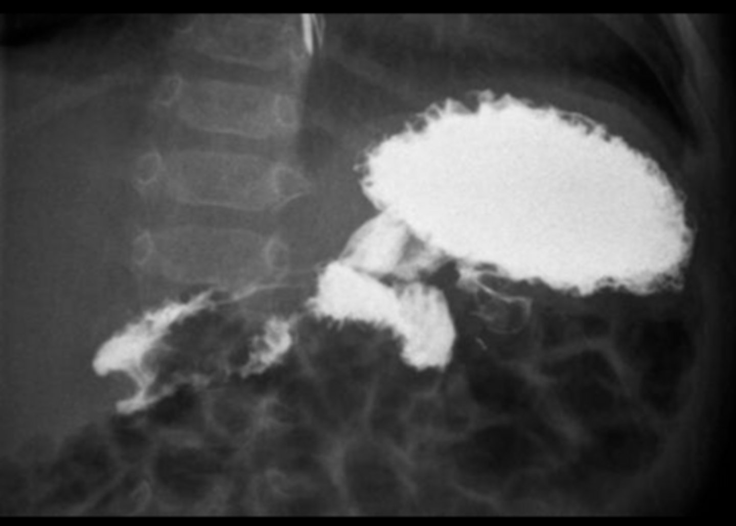 <p>Located left of midline at ligament of Treitz where bowel becomes intraperitoneal jejunum.</p>