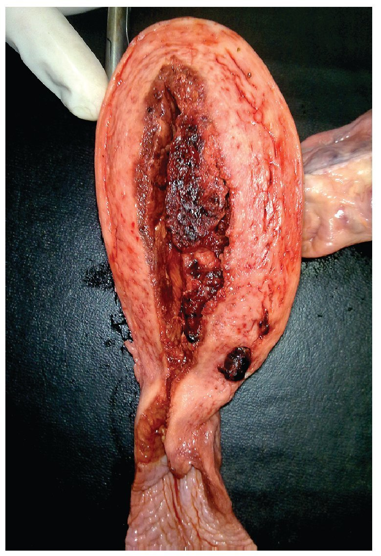 <p><strong>El coriocarcinoma puede aparecer después de:</strong></p>