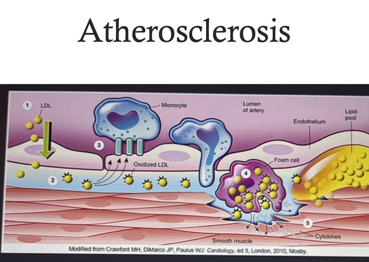 <ul><li><p>1) Things stick to damaged endothelium = release growth factors = becomes permeable = LDL go through and accumulate = macrophages eat LDL and become foam cells = foam cells release cytokines = more macrophages come to site </p><ul><li><p>Lots of inflammation </p></li></ul></li><li><p>2) Fatty streak process begins </p><ul><li><p>Macrophages filled with LDL = foam cells = accumulation of foam cells (macrophages and T cells and T lymphocytes = release growth factors = collagen and smooth muscle cells form cap over fatty cap = artery becomes closed off </p></li><li><p>Patients becomes symptoms when 60-70% of blood vessel is closed off (ischemia - lack of blood flow to organs) </p><ul><li><p>Angina (chest pain due to ischemia) </p></li></ul></li><li><p>Fibrous cap can become eroded due to shear force = platelet form clot = blood flow shut off </p><ul><li><p>Carotid artery = storke</p></li><li><p>Cornary arteries = heart attack </p></li></ul></li></ul></li></ul><p></p>