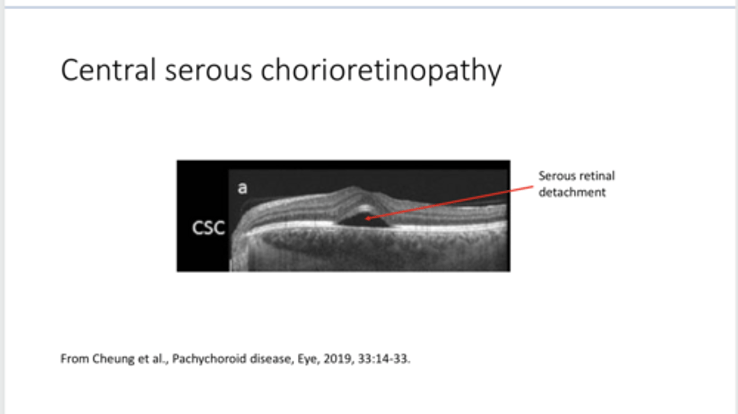 <p>Central Serous Chorioretinopathy on OCT (Pic)</p>