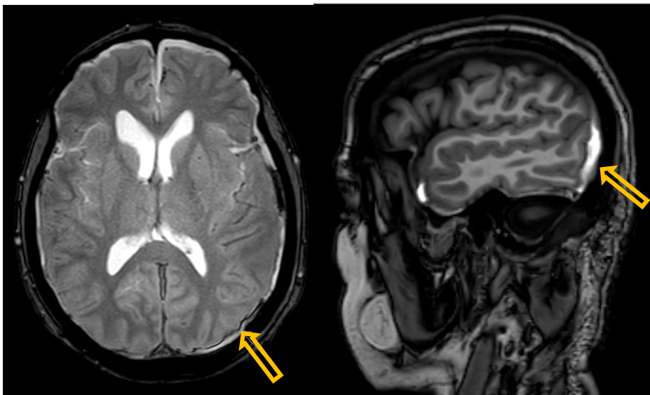 <p>Patient history: headache after head trauma</p><p>Modality: left – T2W axial MRI; right – T1W sagittal MRI (without iv. contrast agent) </p><p>Region: brain, axial (left and middle) and sagittal (right) planes </p><p>Radiologic sign: crescent-shaped, hyperintense area in the subdural space (yellow arrow)</p><p>Diagnosis: left-sided acute parieto-occipital subdural hematoma</p>