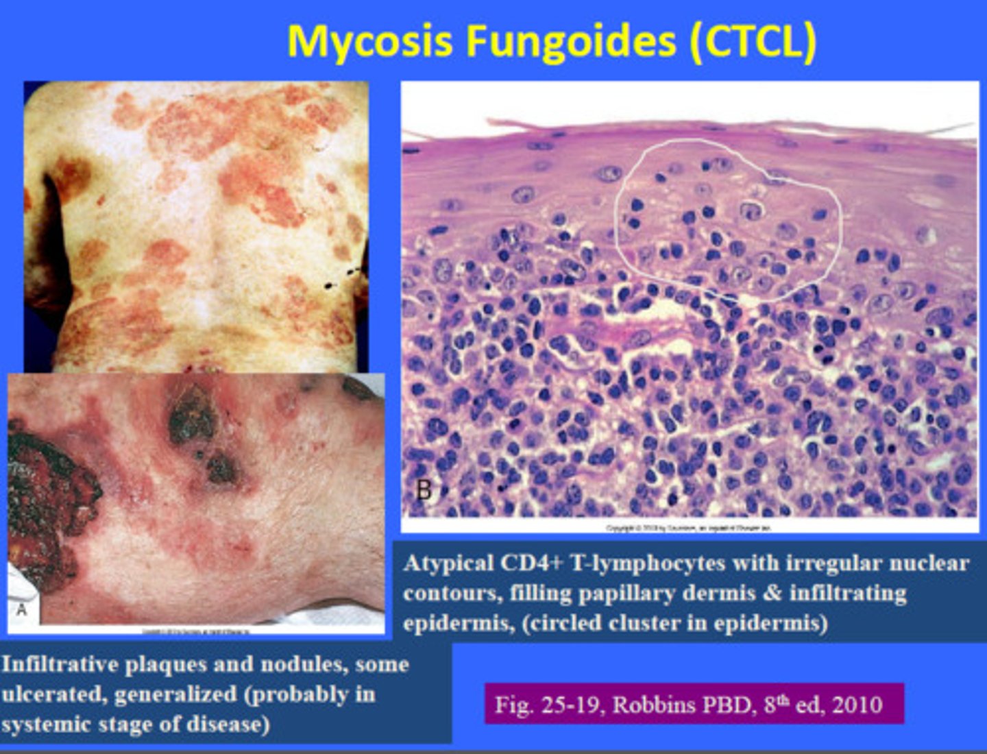 <p>fungal infection of the body</p>