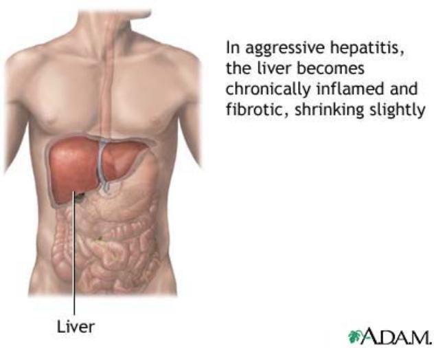 <p>Hepatitis A</p>