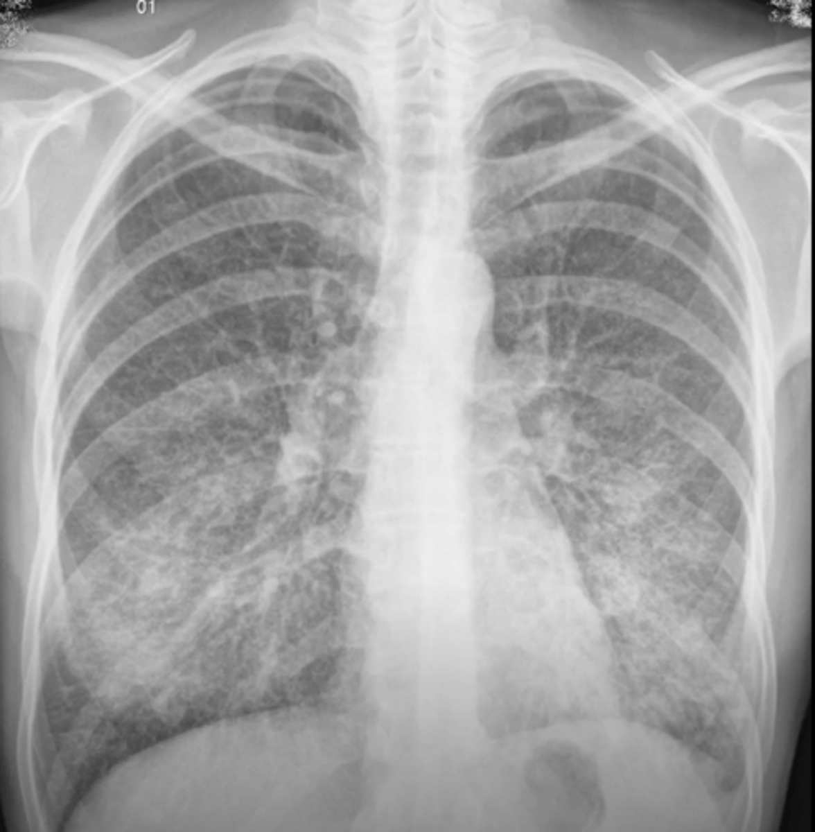 <p>(CXR examples) patchy reticular opacities; especially in perihylar lung; mostly caused by mycoplasma and chlamydia</p>